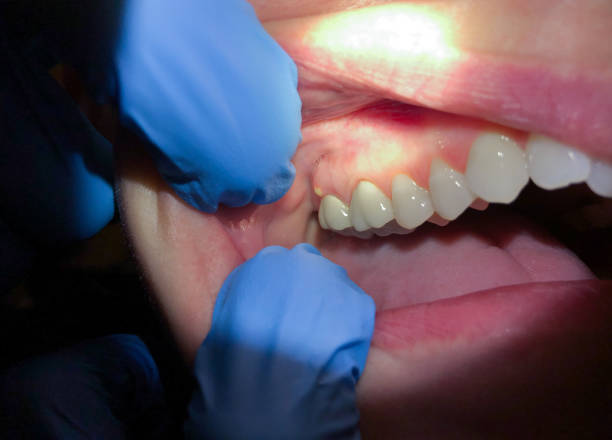 Emergency Dental Filling Replacement in ME